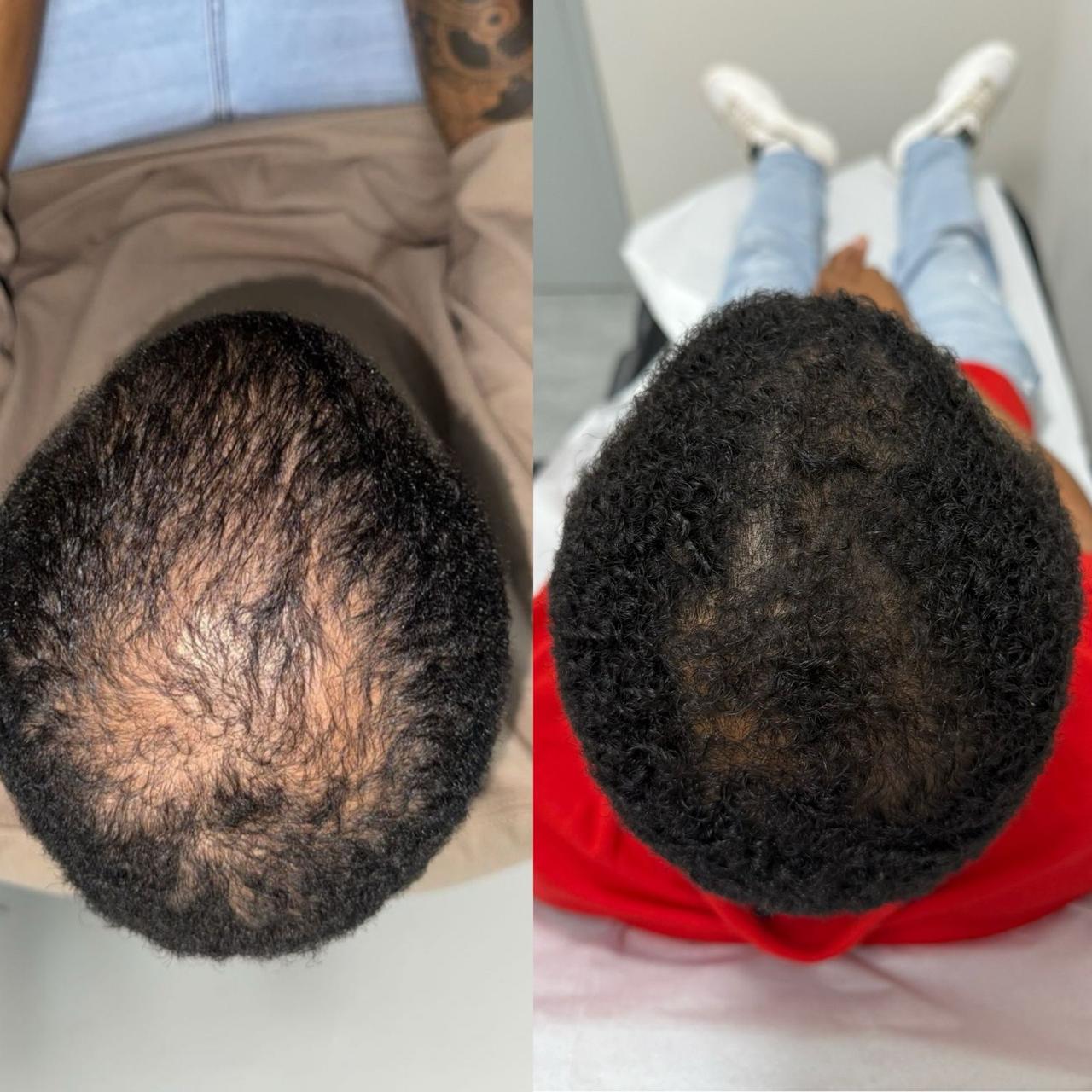 Resultado tratamento capilar