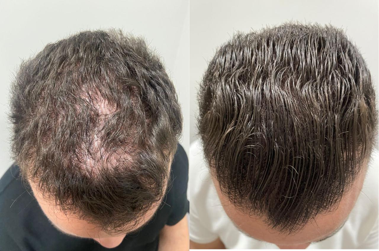 Resultado tratamento capilar